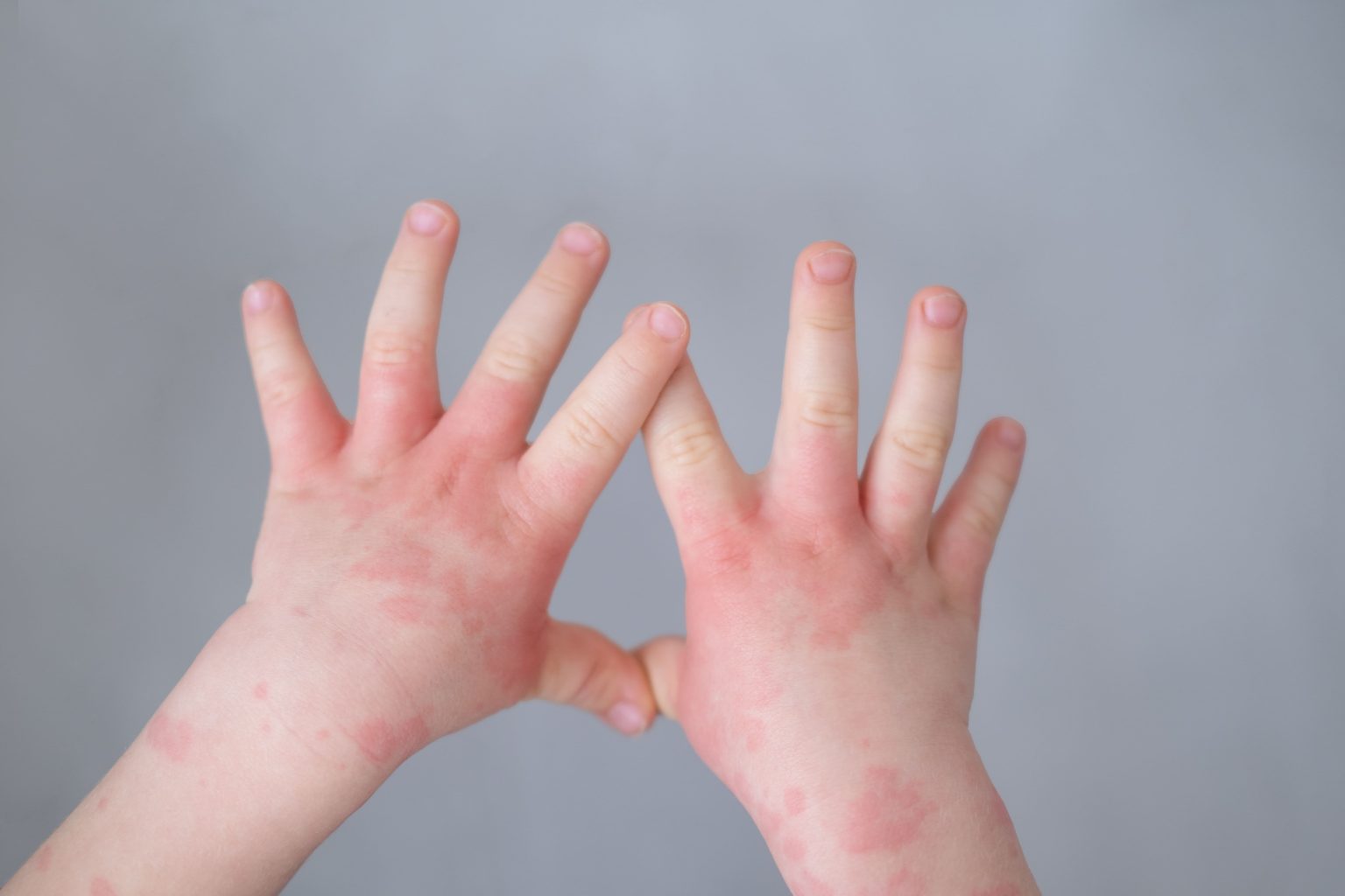新生兒臉起疹子了？常見嬰兒皮膚紅疹區分方法以及照顧治療一次看
