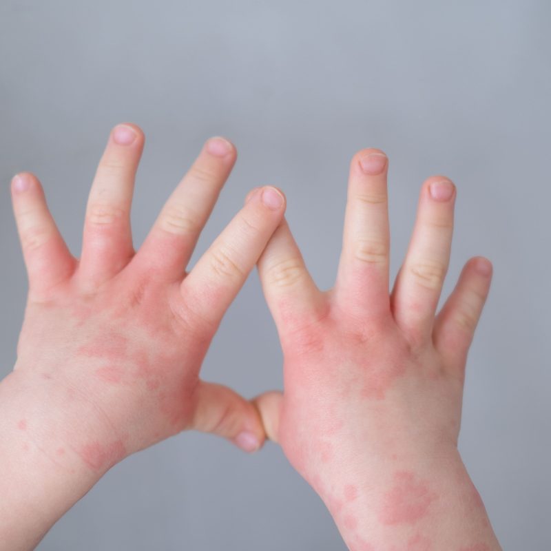 新生兒臉起疹子了？常見嬰兒皮膚紅疹區分方法以及照顧治療一次看